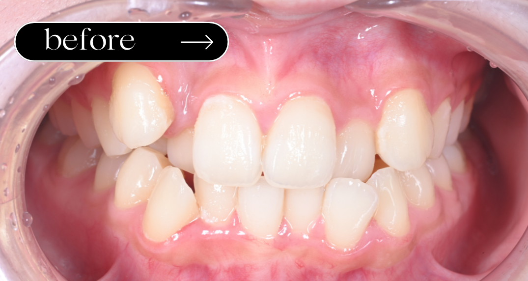 八重歯の矯正BeforeAfter 2年 高校生女性