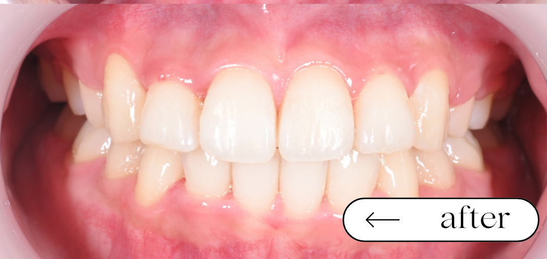 八重歯の矯正BeforeAfter 2年 高校生女性