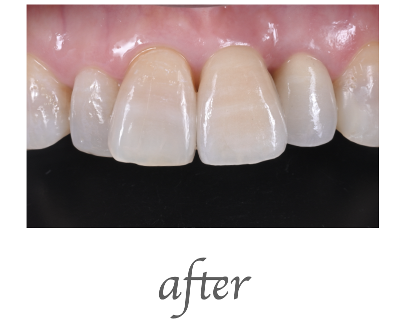 インプラント画像