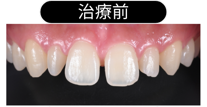 部分矯正＋ラミネートベニア投稿