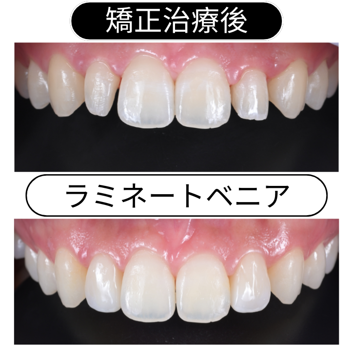 部分矯正＋ラミネートベニア投稿