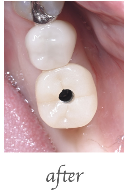 インプラント仮歯