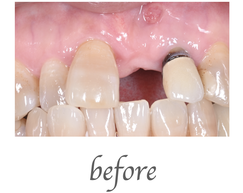 インプラント画像