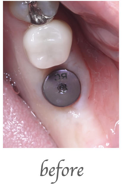 インプラント仮歯